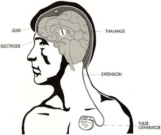 BRAIN SURGERY FOR PARKINSON&rsquo;S DISEASE