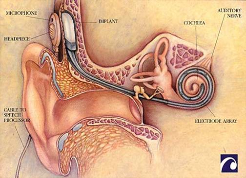 COCHLEAR IMPLANT